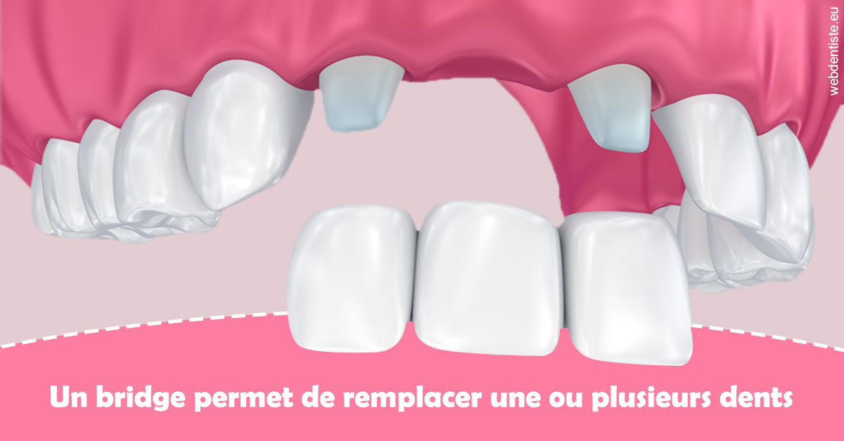 https://dr-hassaneyn-allemand.test-moncomptewebdentiste.fr/Bridge remplacer dents 2