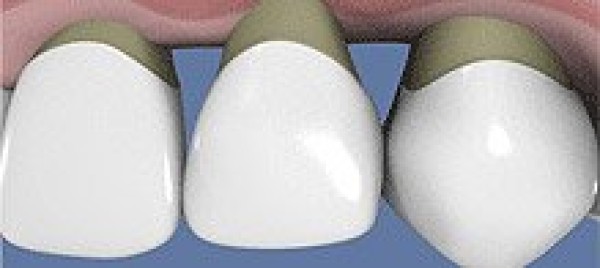 Zahnfleischrückbildung nach Parodontalbehandlung
