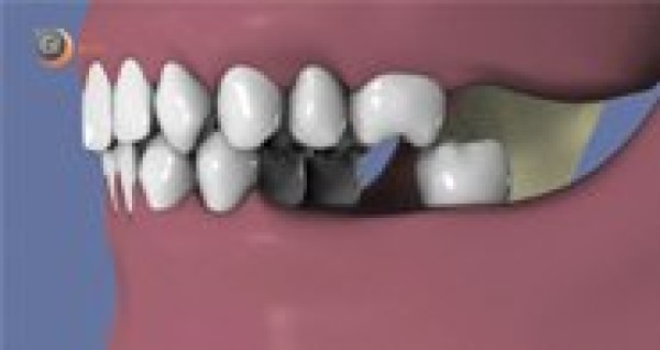 Warum einen fehlenden Zahn ersetzen?