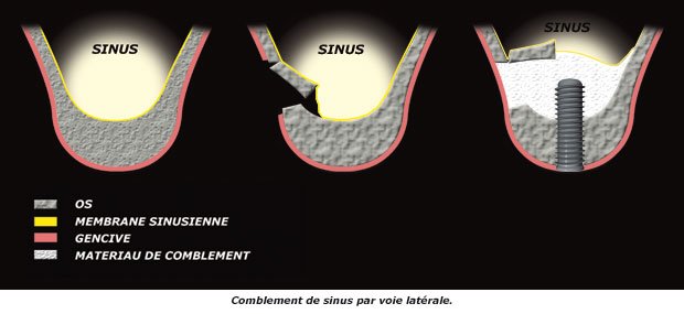 sinus-lateral (1)