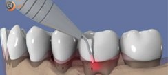 vigentte_pourquoi_utiliser_le_laser_en_dentisterie