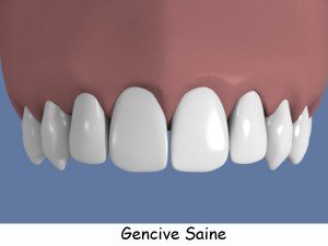 gencive-saine-legende2-300x225 (1)
